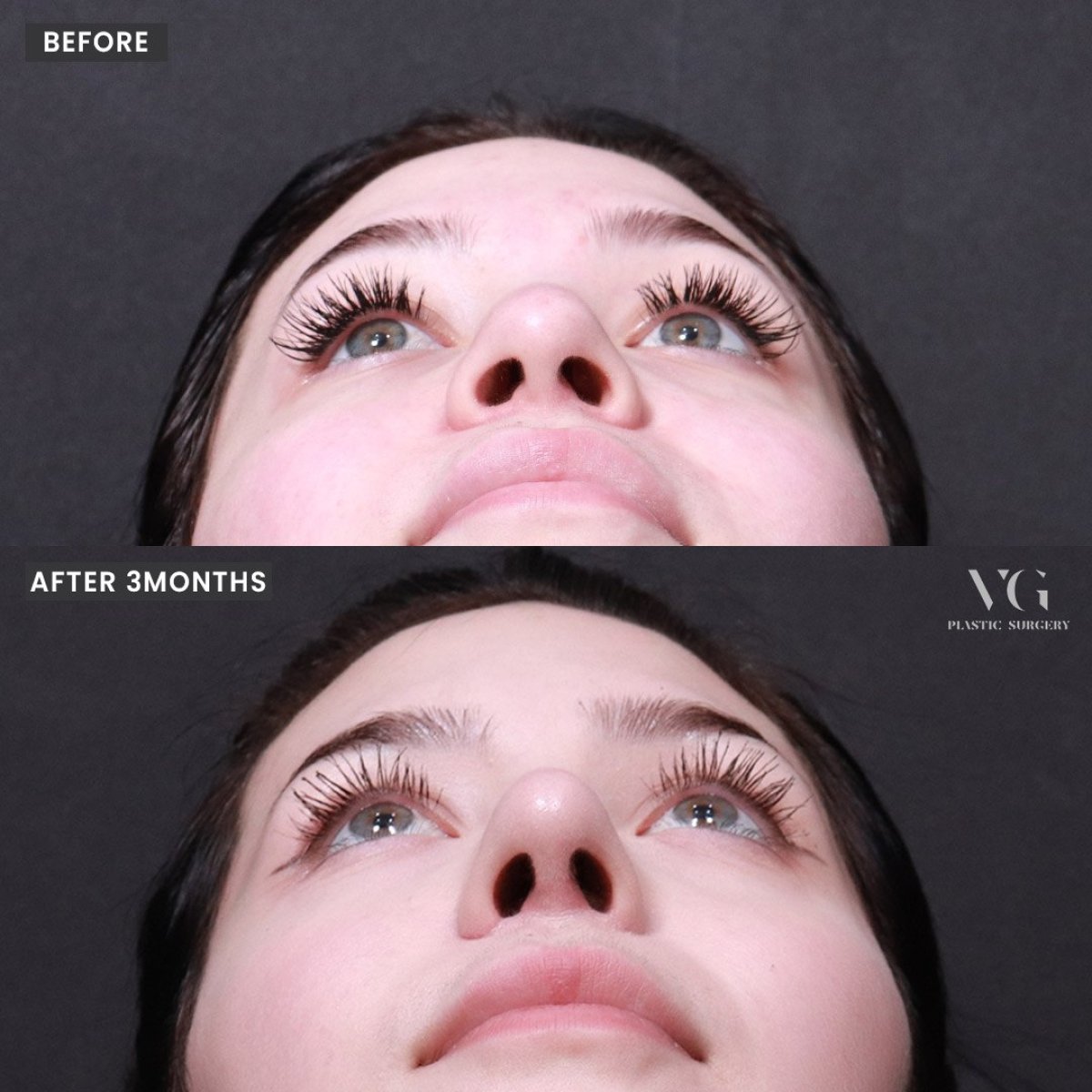 Результаты ринопластики до и после в VG Plastic Surgery, коррекция носа через 3 месяца