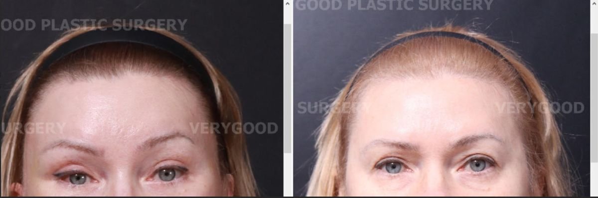 Resultados de lifting de cejas antes y después en VG Plastic Surgery, cejas más elevadas