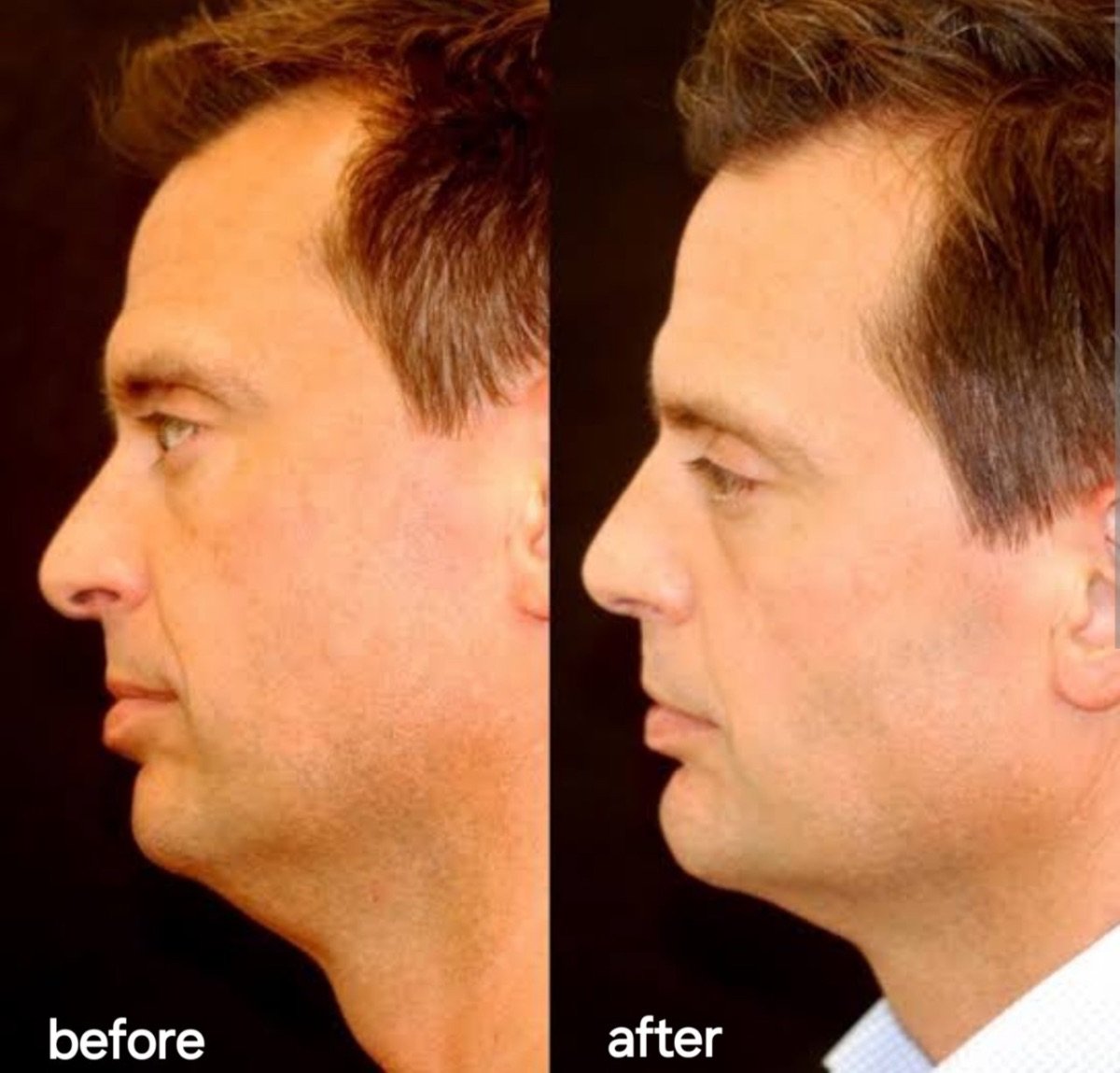 Resultados antes y después de Deep Plane Facelift en ID Clinic Bangkok, mejora de la mandíbula