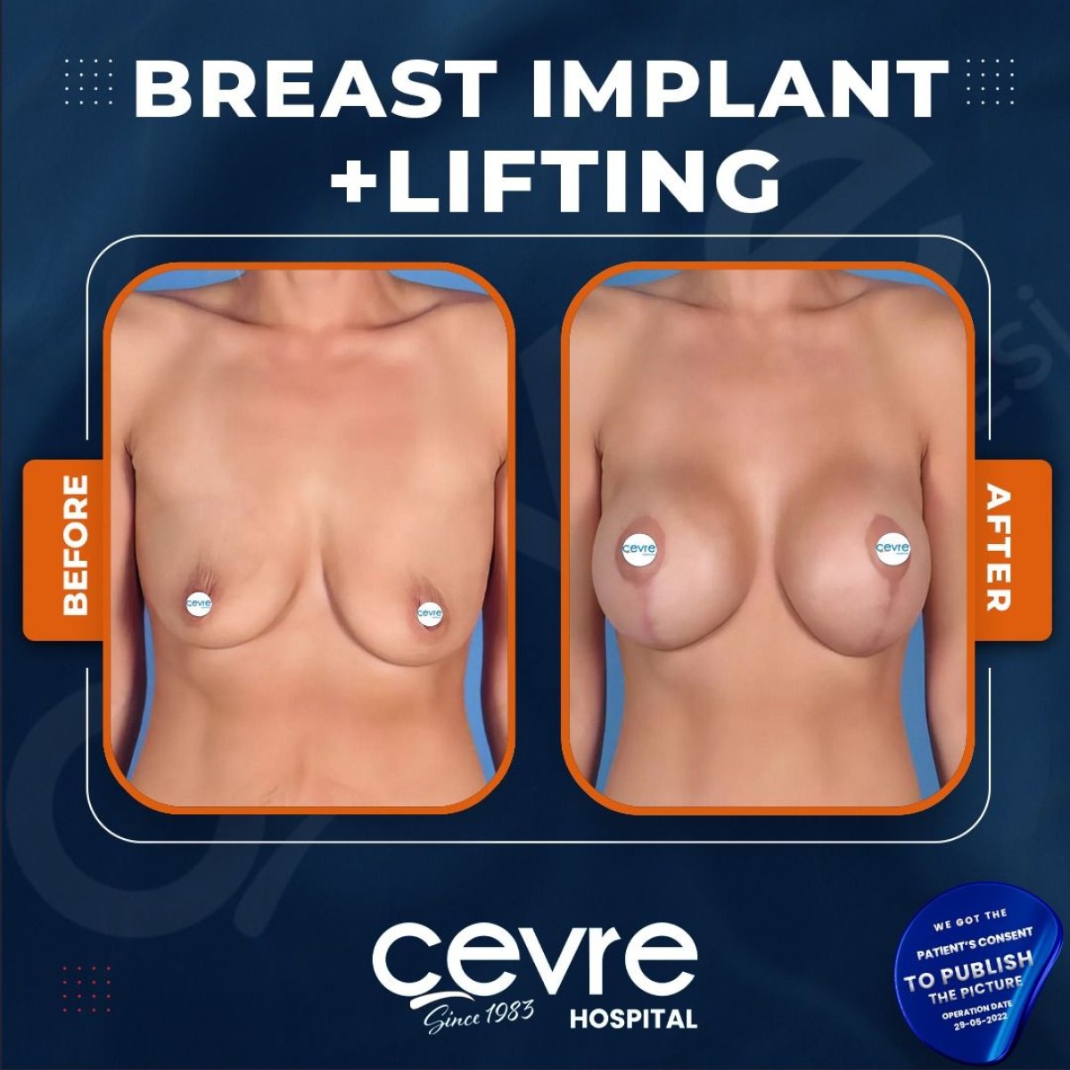 Before and after breast augmentation results at Adem and Havva Medical Center, fuller lifted breasts