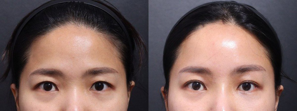 Resultados de blefaroplastia antes y después en VG Plastic Surgery, corrección de párpados