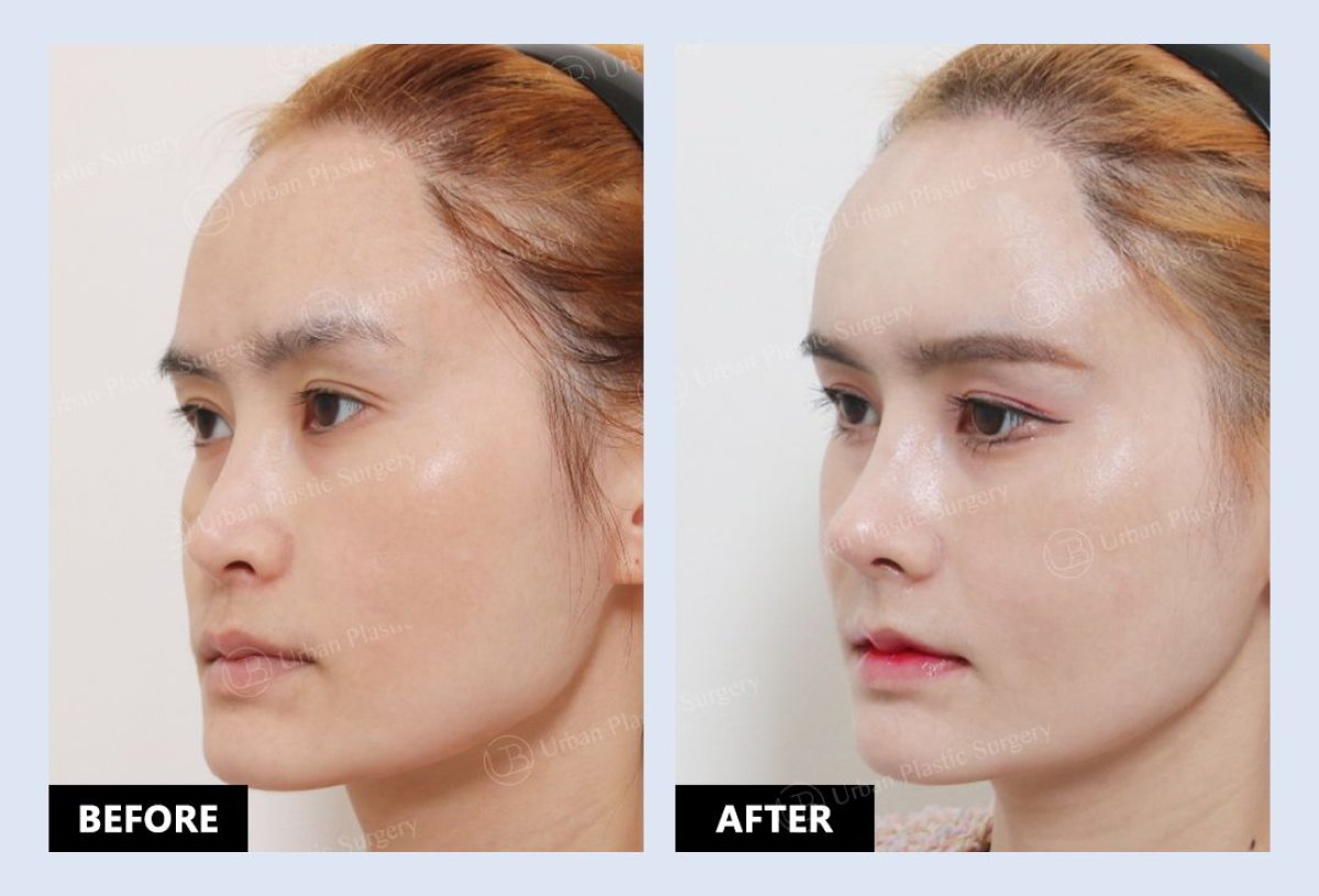 Resultados de lipofilling antes y después en URBAN Plastic Surgery – mayor volumen facial