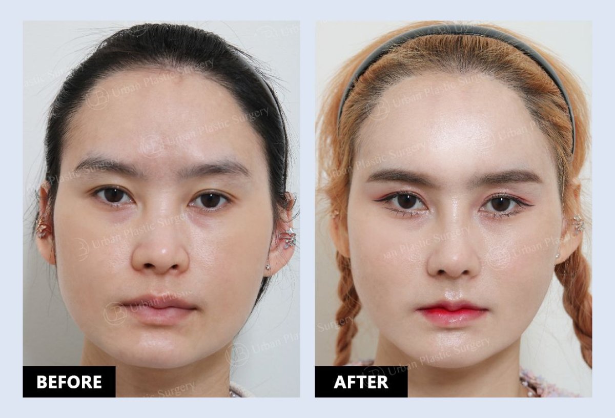 Resultados de lipofilling antes y después en URBAN Plastic Surgery – mayor volumen facial