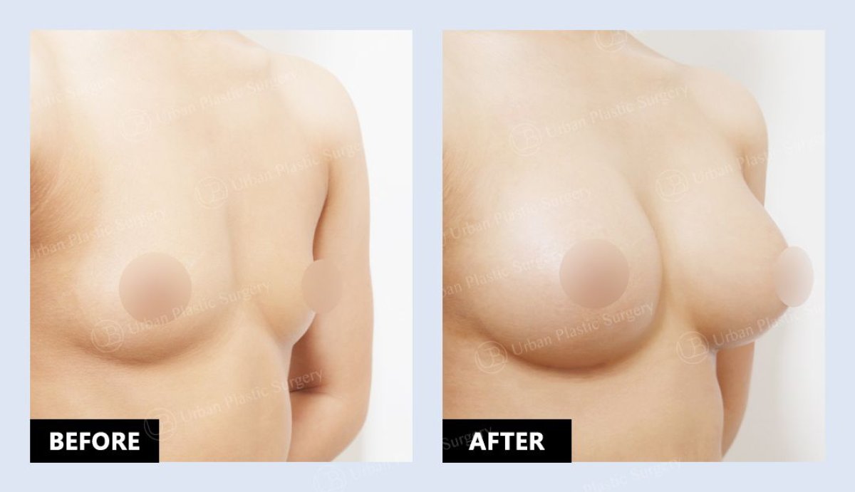 Vorher-nachher-Ergebnis Brust-Lipofilling bei URBAN Plastic Surgery – mehr Brustvolumen