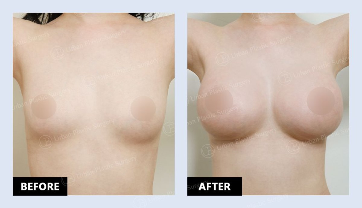 Résultats avant/après lipofilling mammaire chez URBAN Plastic Surgery – volume naturel