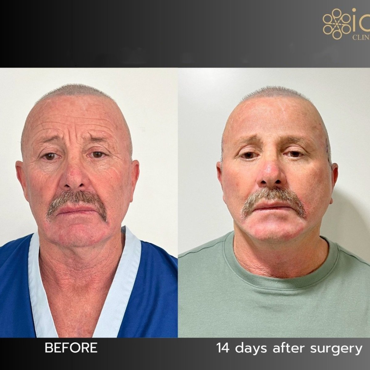 Before and after deep plane facelift results at ID Clinic Bangkok, visible facial rejuvenation