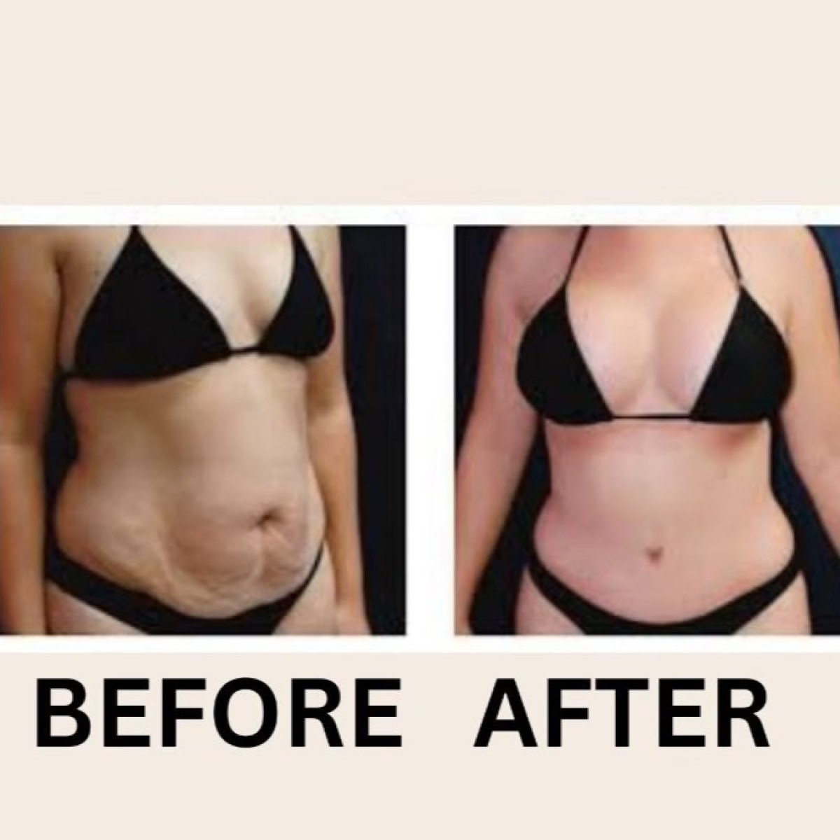 Full body lift before and after results at ID Clinic Bangkok – improved body contour and skin