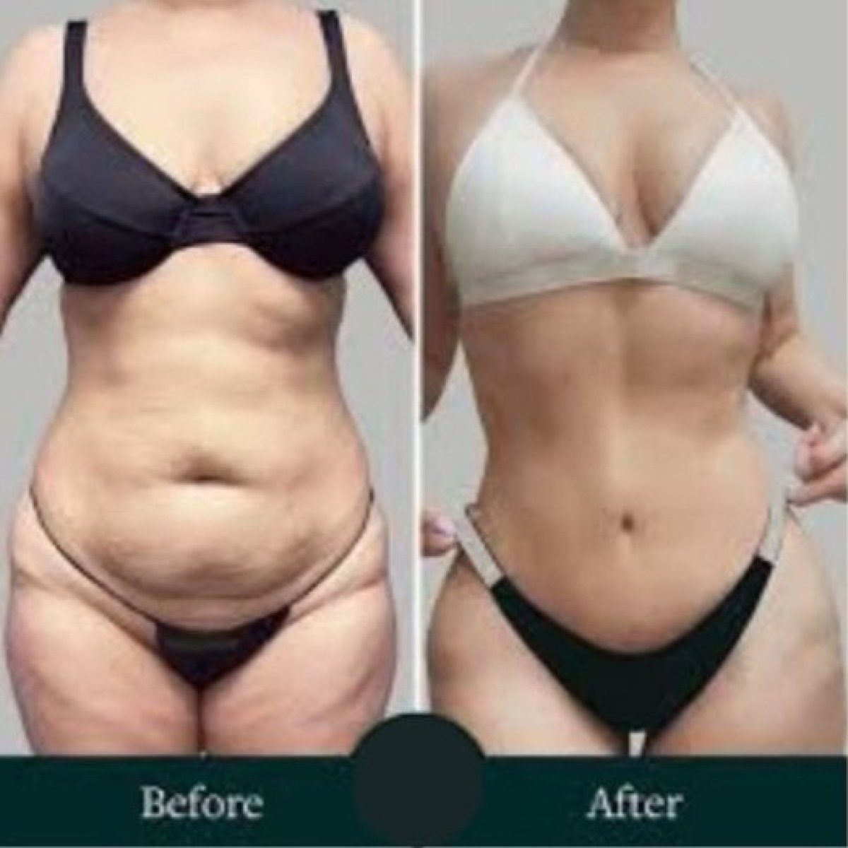 Before and after full body lift results at ID Clinic Bangkok, improved body contour and firmness