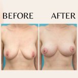 Fotos vor und nach Brustvergrößerung durch Dr. Dr Phatcharasak Kraisornphongsakul Md