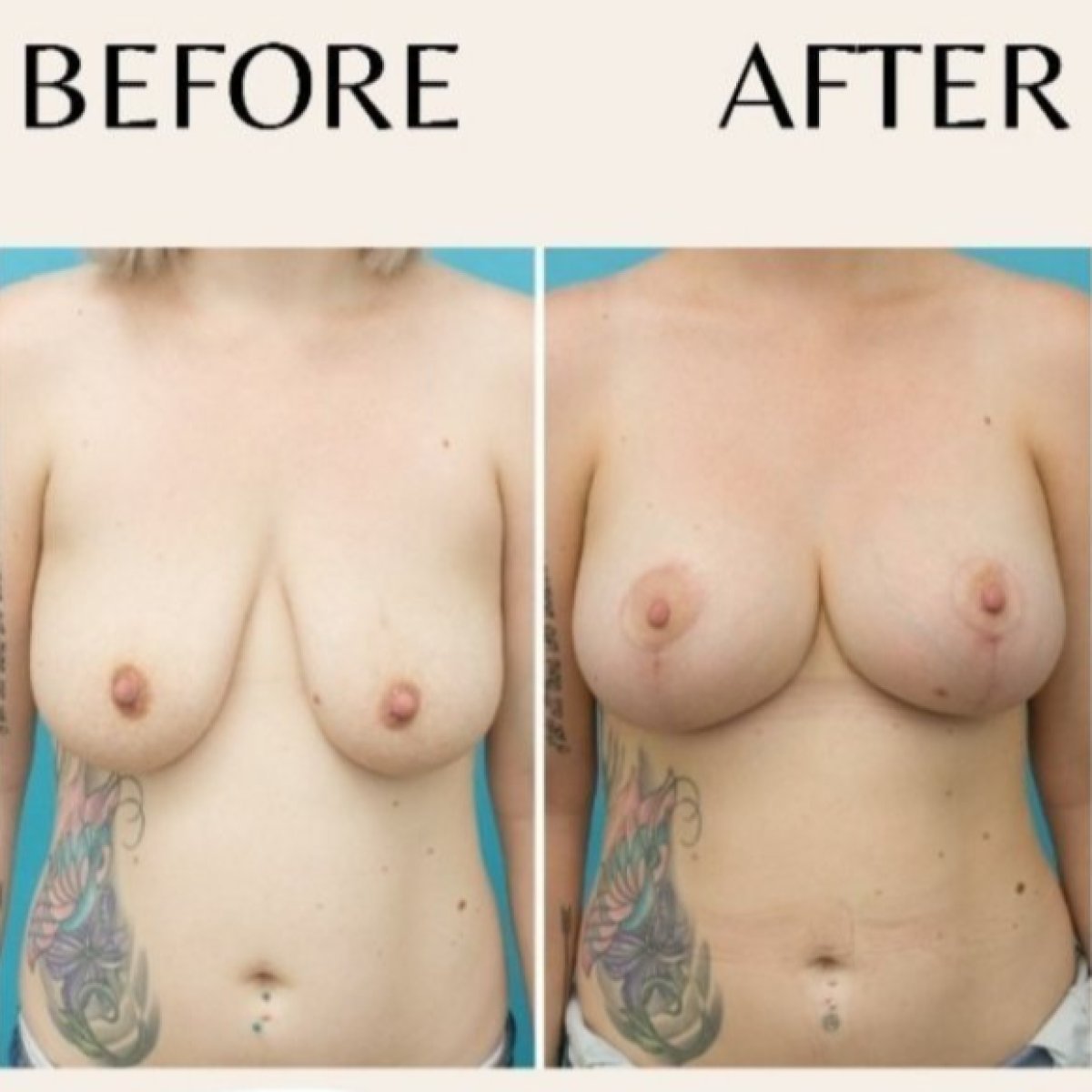 Before and after breast augmentation results at ID Clinic Bangkok, enhanced breast shape