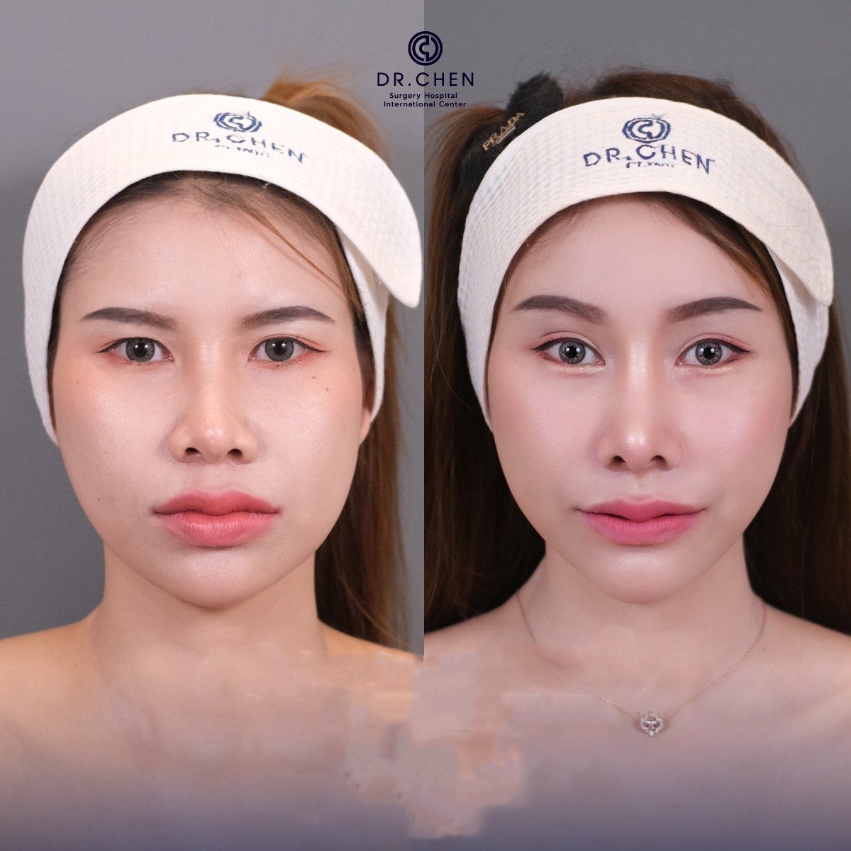 قبل وبعد حقن البوتوكس في Dr. Chen Surgery Hospital International Center، نتيجة تجديد الوجه