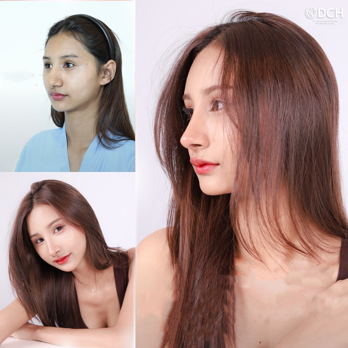 قبل وبعد حقن البوتوكس في Dr. Chen Surgery Hospital International Center، نتيجة تجديد الوجه
