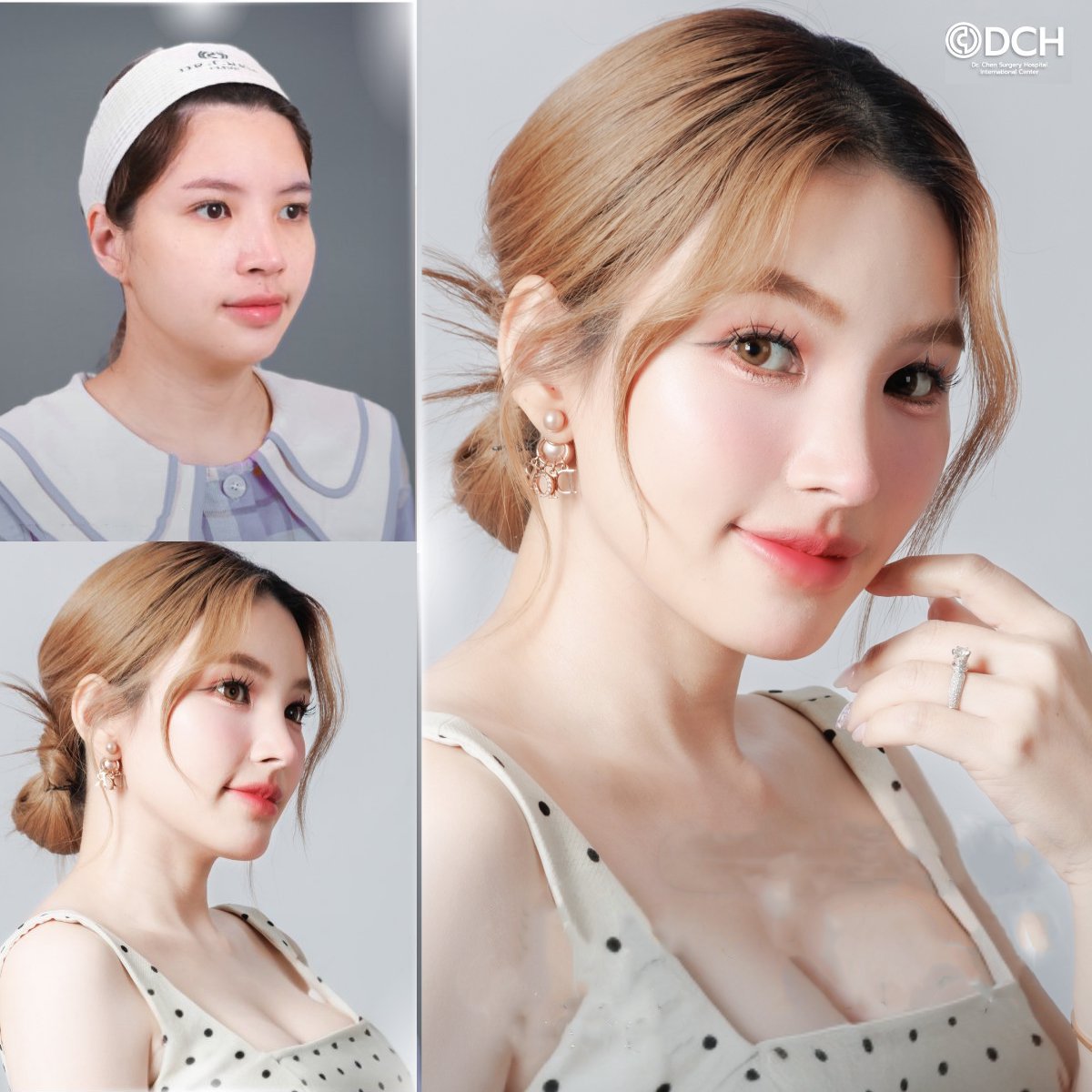 نتائج عملية تجميل الأنف قبل وبعد في Dr. Chen Surgery Hospital International Center، أنف مصقول