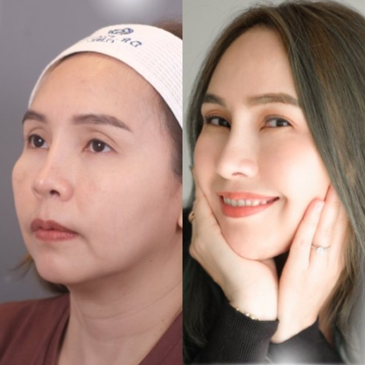نتيجة عملية تجميل الأنف قبل وبعد في Dr. Chen Surgery Hospital International Center، إعادة تشكيل الأنف