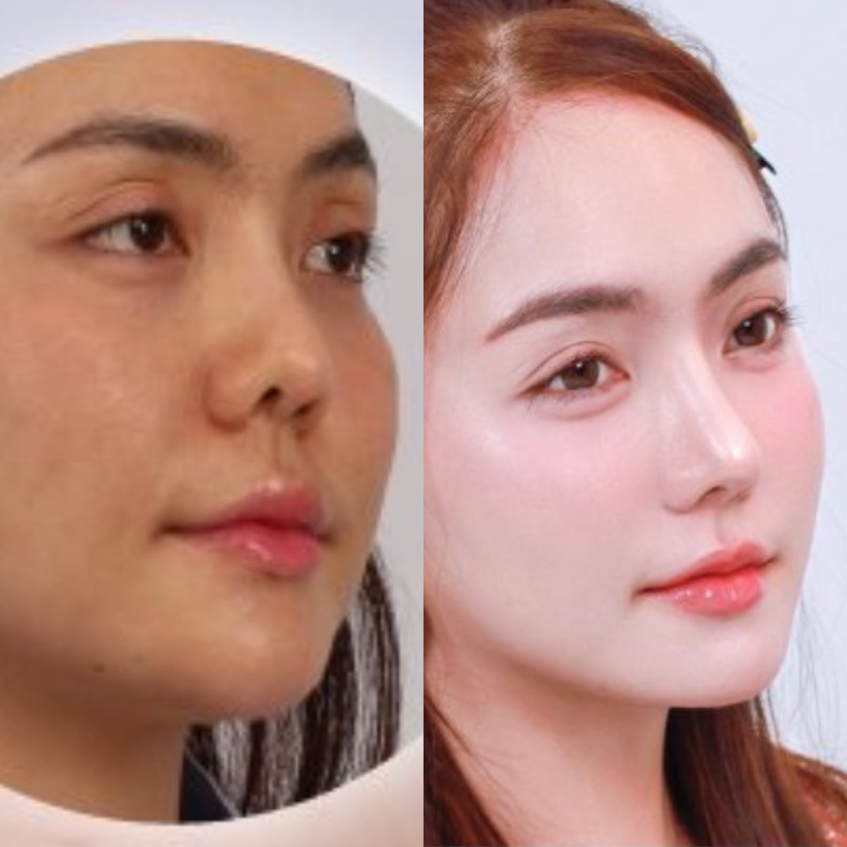 نتائج عملية تجميل الأنف قبل وبعد في Dr. Chen Surgery Hospital International Center، إعادة تشكيل الأنف