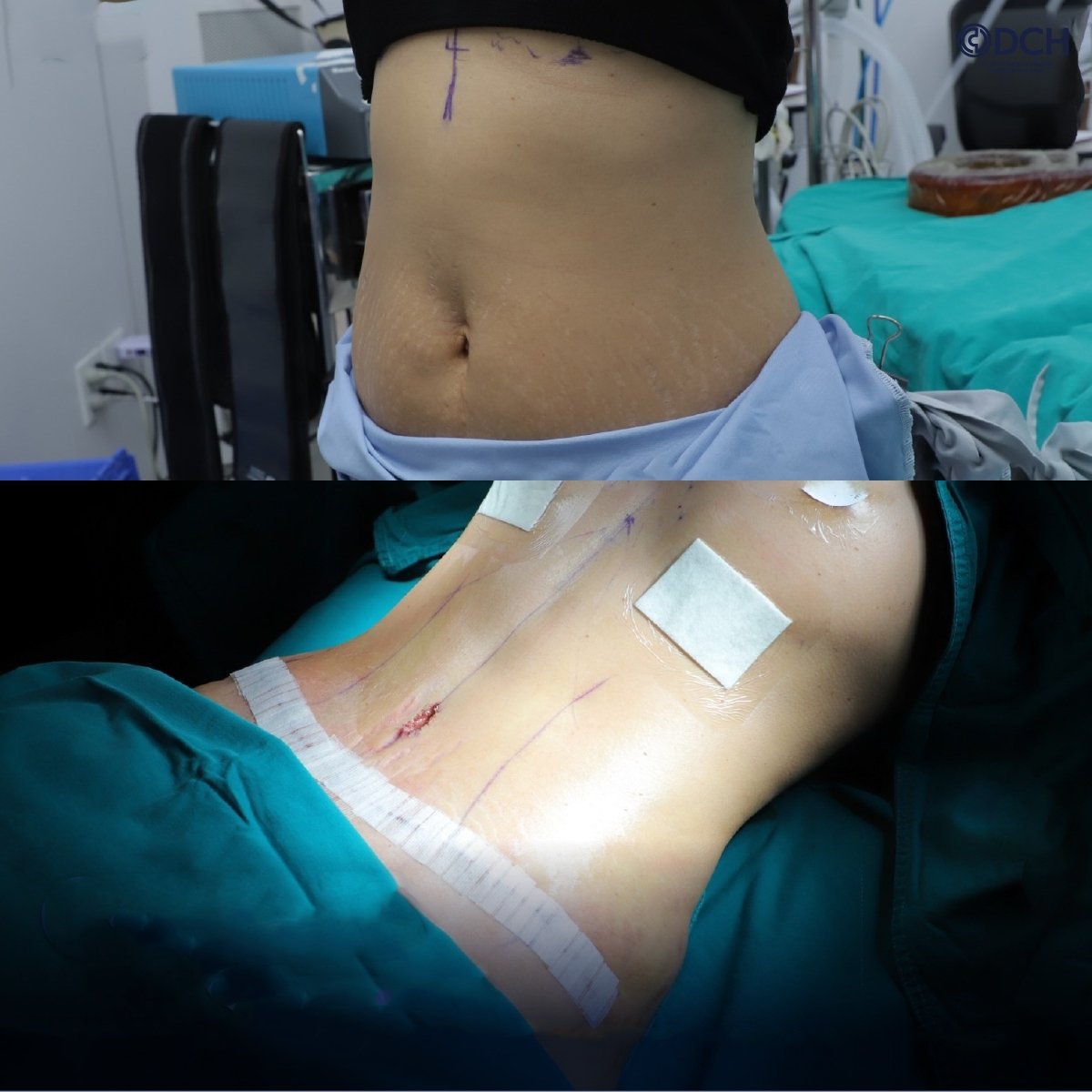 نتائج شفط الدهون قبل وبعد في Dr. Chen Surgery Hospital International Center، البطن