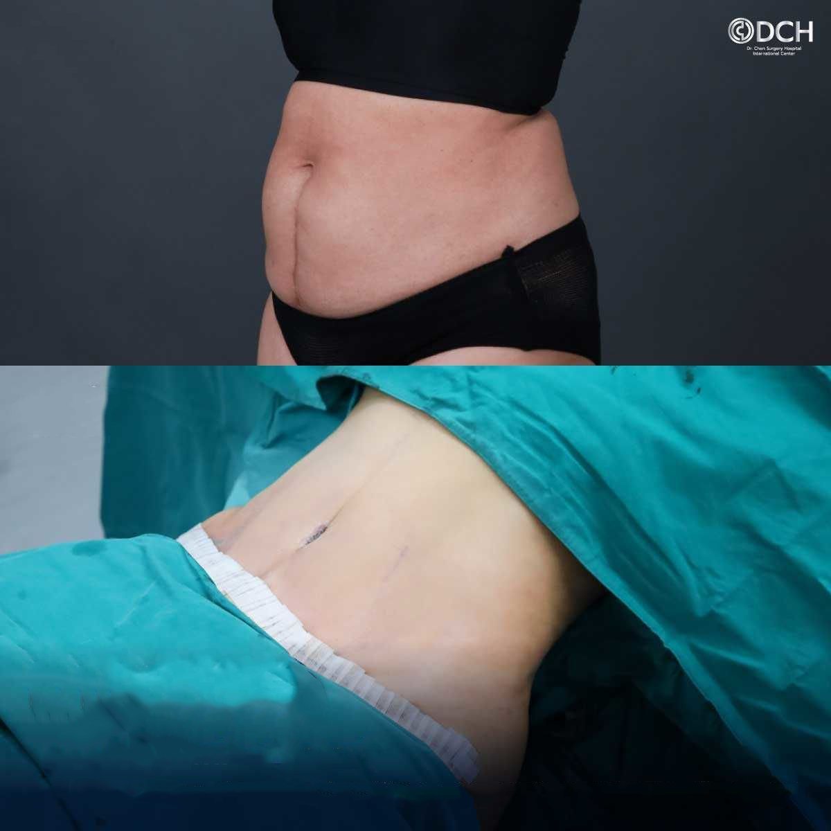 نتائج شد البطن قبل وبعد في Dr. Chen Surgery Hospital International Center، بطن مسطح