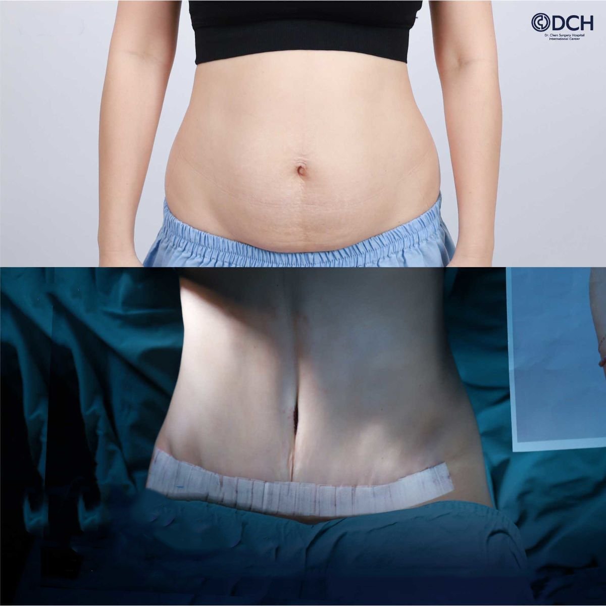 نتائج شد البطن قبل وبعد في Dr. Chen Surgery Hospital International Center، تحديد البطن