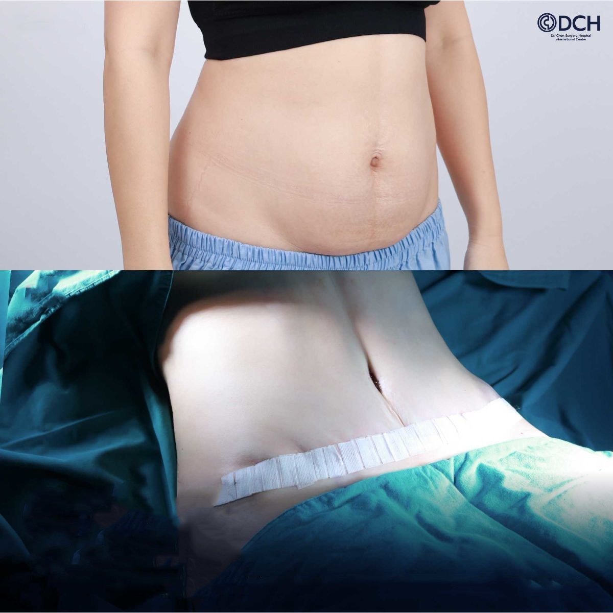 نتائج شد البطن قبل وبعد في مركز Dr. Chen Surgery Hospital International Center، تحديد البطن