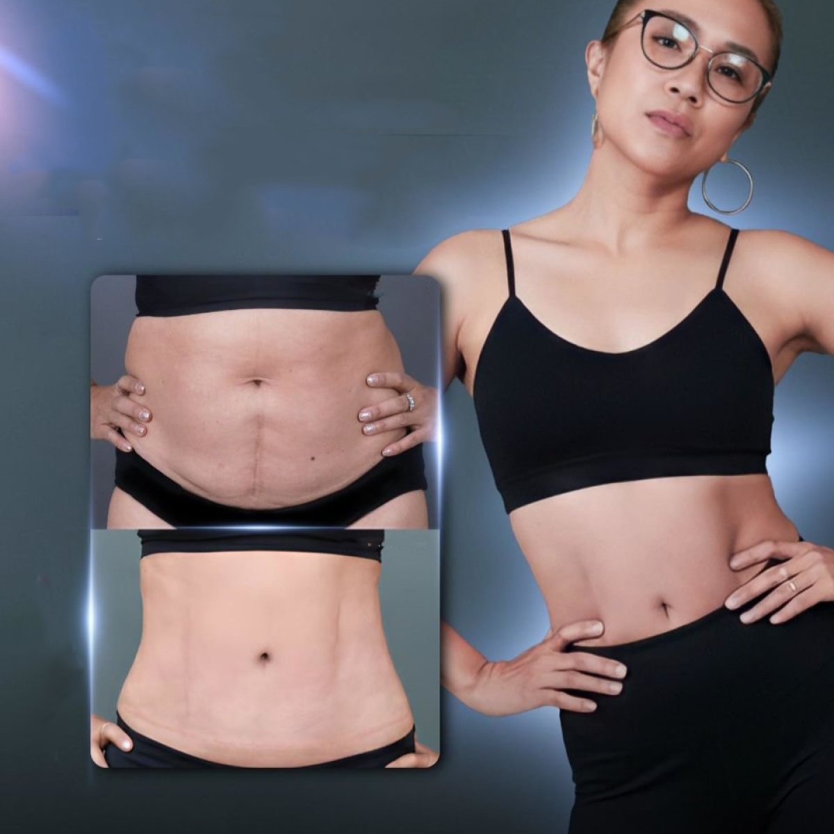 نتائج شد البطن قبل وبعد في Dr. Chen Surgery Hospital International Center، بطن مسطح