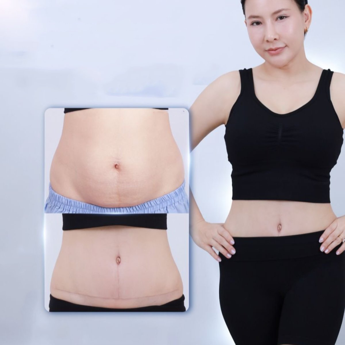 نتائج شد البطن قبل وبعد في Dr. Chen Surgery Hospital International Center، بطن مسطح