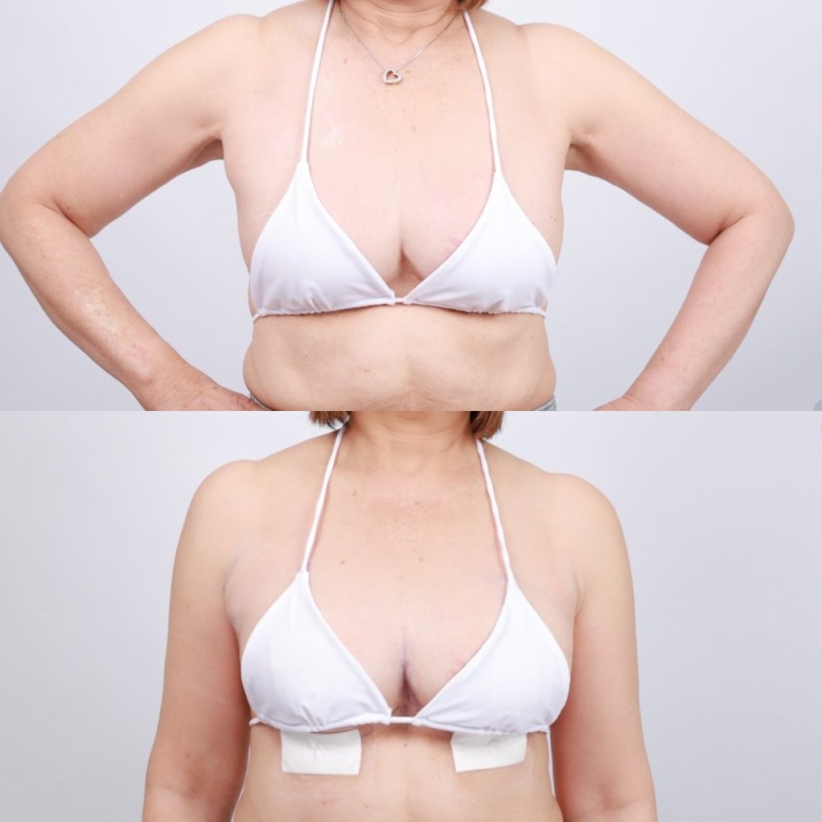 نتائج تكبير الثدي قبل وبعد في Dr. Chen Surgery Hospital International Center