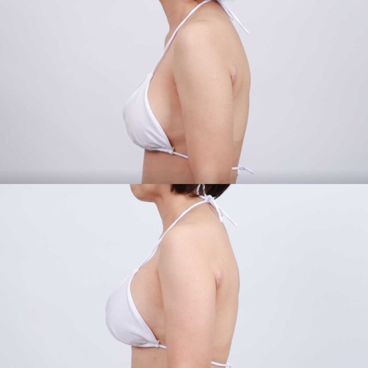 Before and after breast augmentation results at Dr. Chen Surgery Hospital International Center