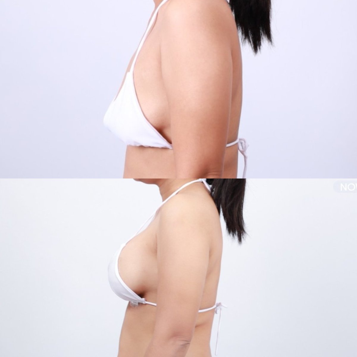 Before and after breast augmentation results at Dr. Chen Surgery Hospital International Center