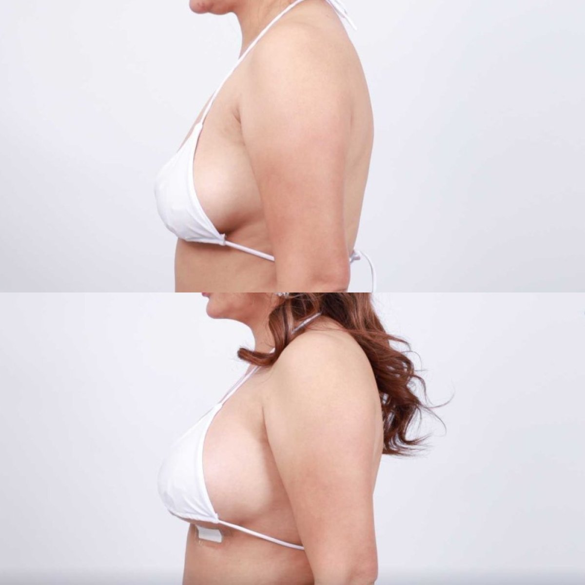 Before and after breast augmentation result at Dr. Chen Surgery Hospital International Center