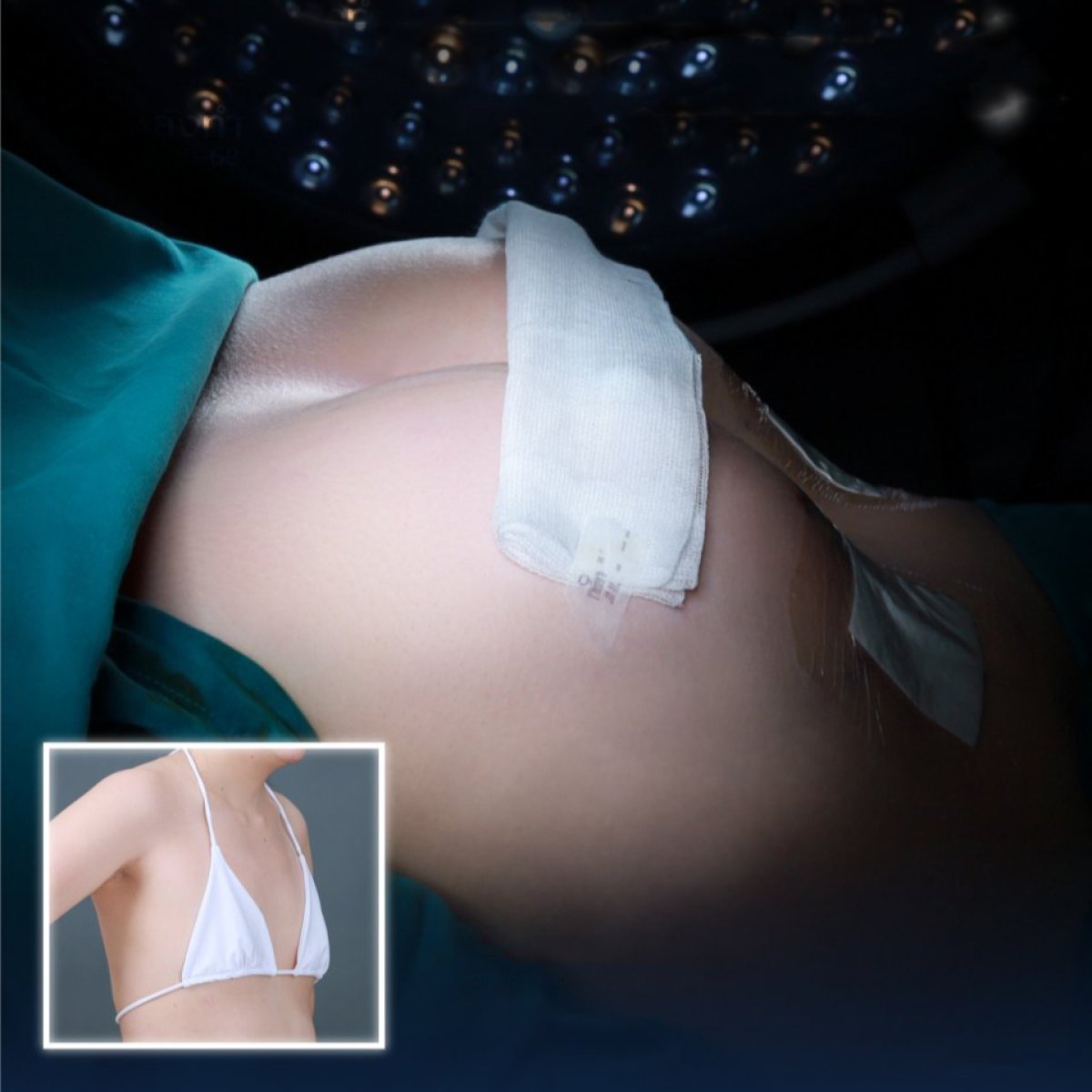 نتائج قبل وبعد تكبير الثدي في Dr. Chen Surgery Hospital International Center
