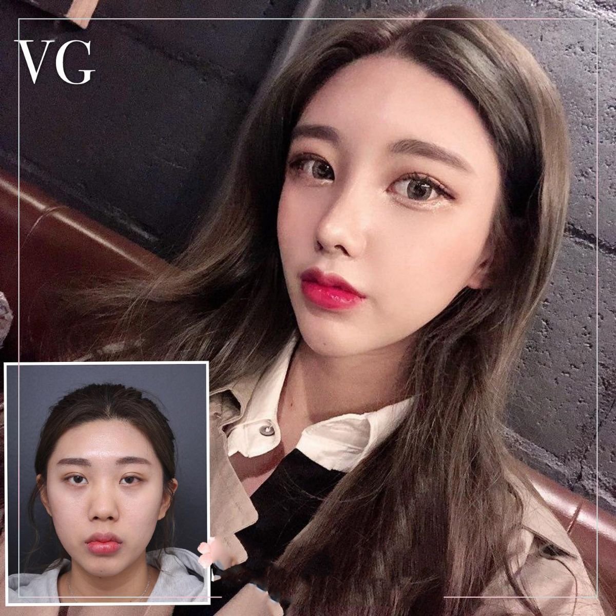 نتائج قبل وبعد Fox Eye Lift في VG Plastic Surgery، تحسين شكل ورفع العين