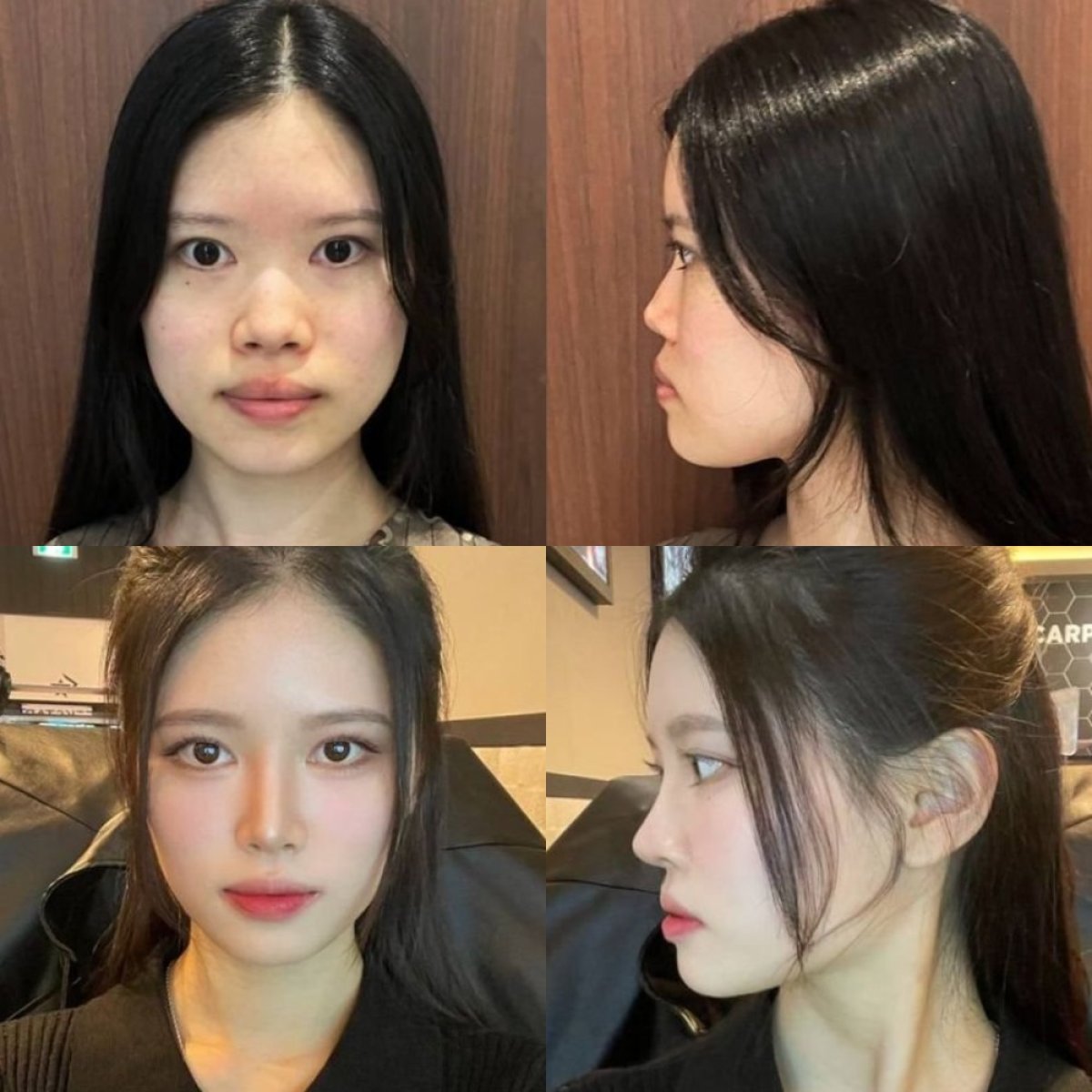 نتائج قبل وبعد Fox Eye Lift في VG Plastic Surgery، تحسين محيط العين والحاجب