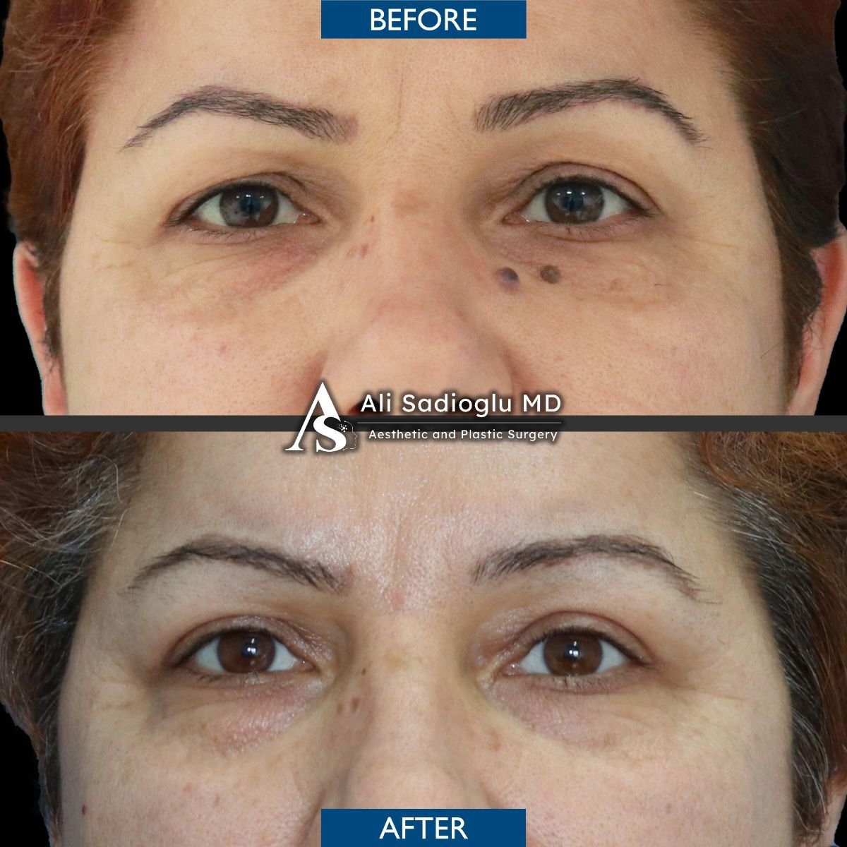 Résultats avant/après blépharoplastie à la clinique Dr. Safa Manav, correction des paupières
