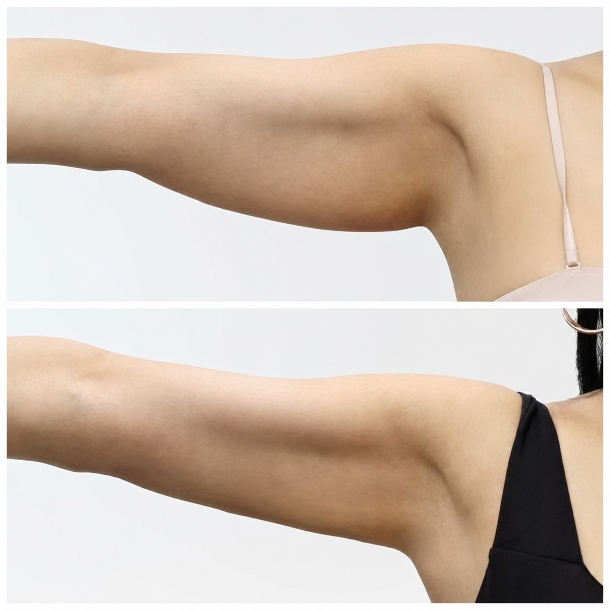 Before and after arm lift (brachioplasty) results at Wansiri Hospital, improved arm contour