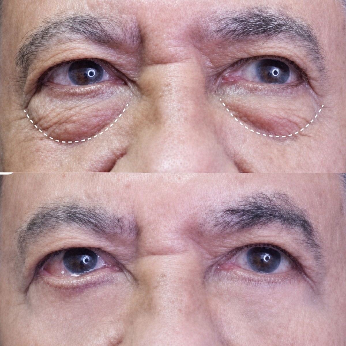 Before and after upper eyelid surgery results at Asia Cosmetic Hospital, reduced eye bags