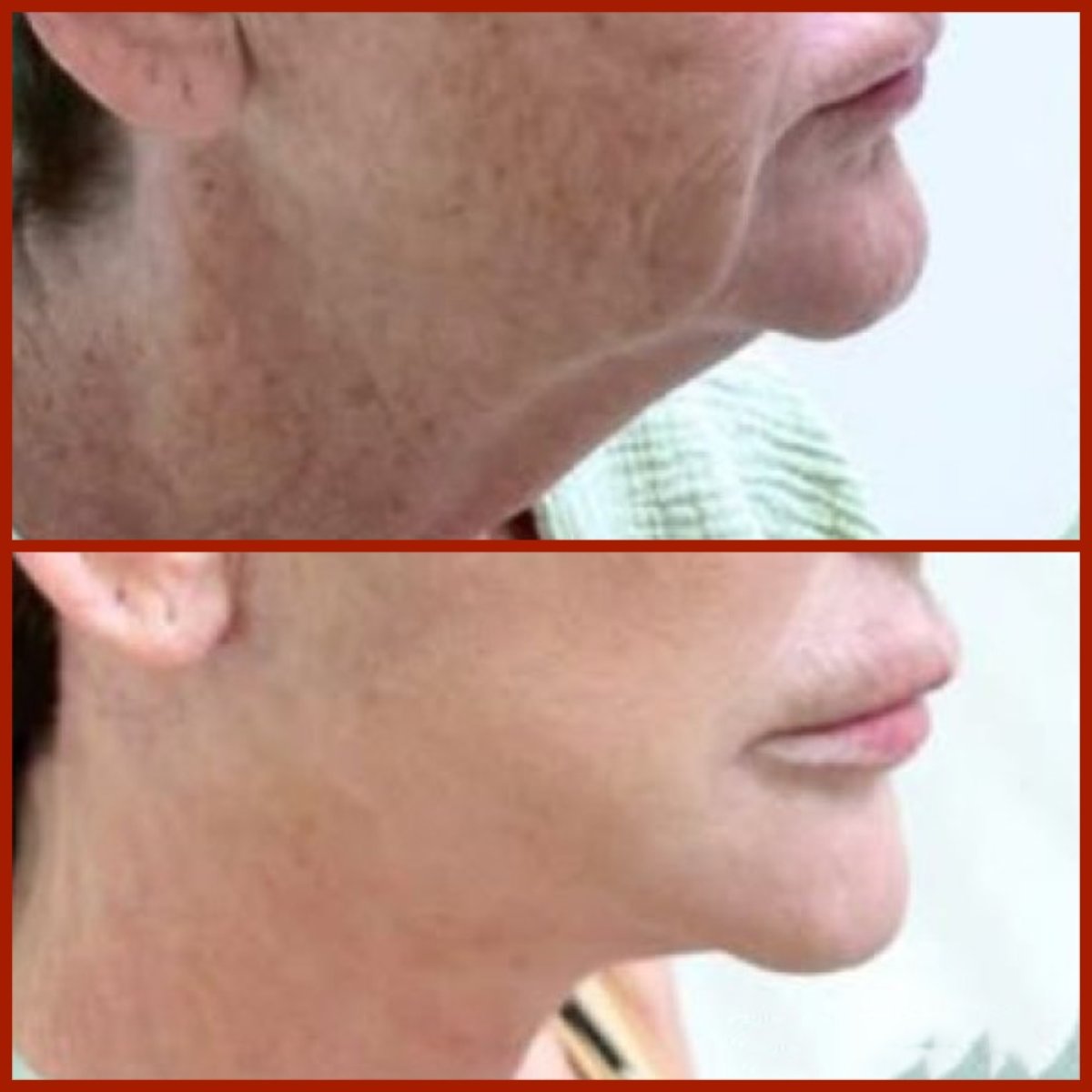 Resultados de lifting de cuello antes y después en DGB Clinic, piel más firme y contorno mejorado