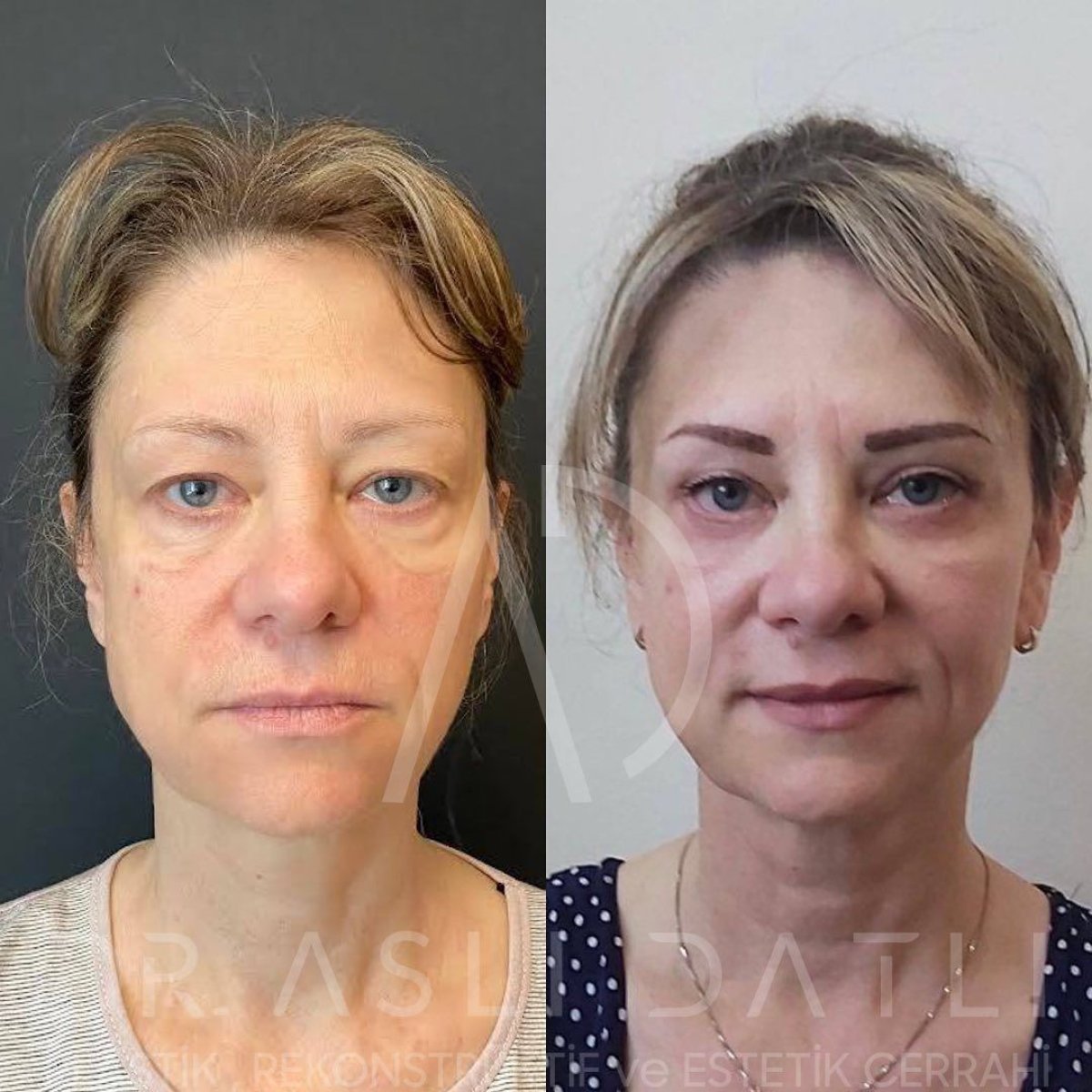Résultats avant/après Fox Eye Lift à Liv Hospital Ulus, amélioration visible des paupières et sourcils
