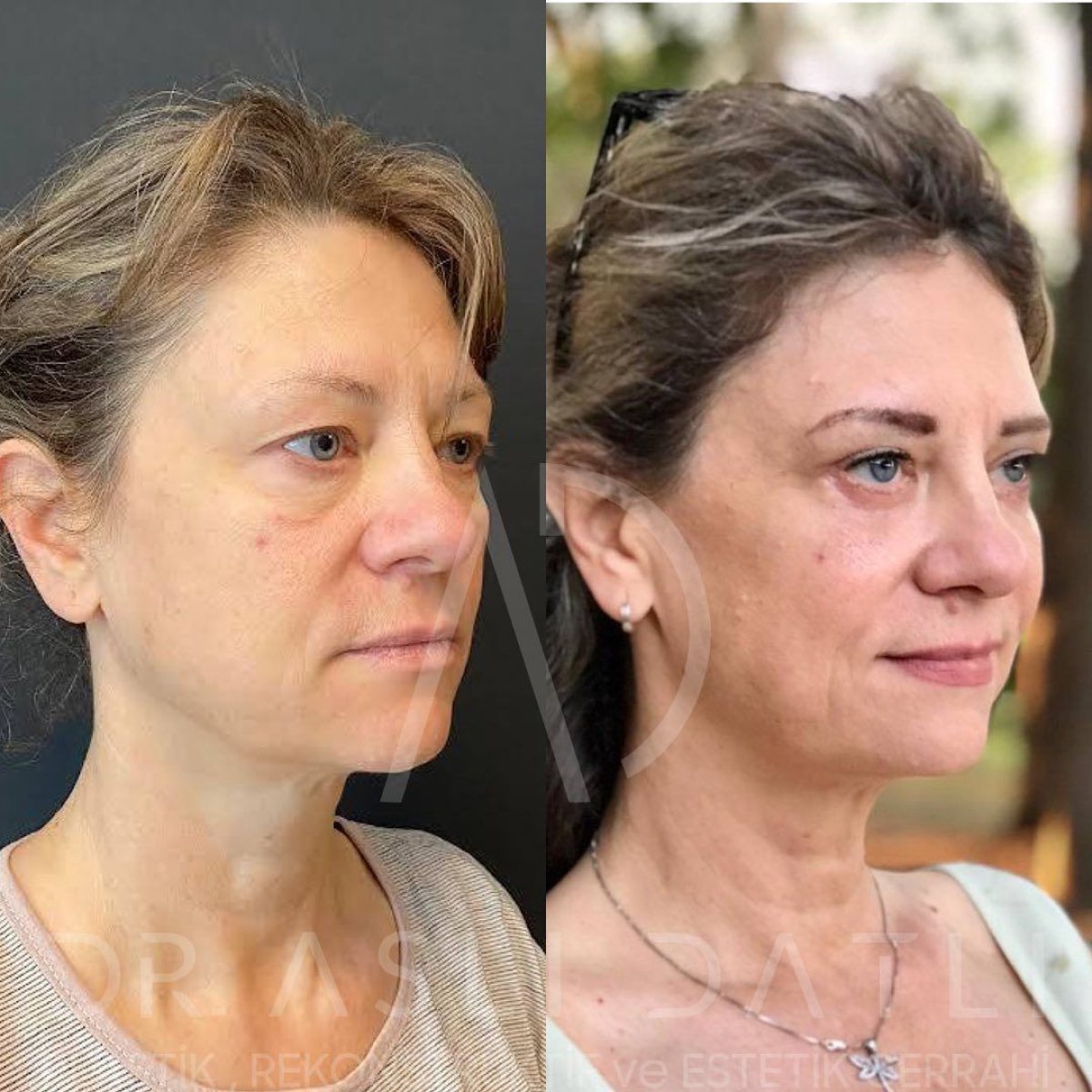 Résultats avant/après Fox Eye Lift à Liv Hospital Ulus, effet liftant visible des paupières