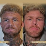 Before and after Blepharoplasty (Eyelid correction) photos by Dr. 