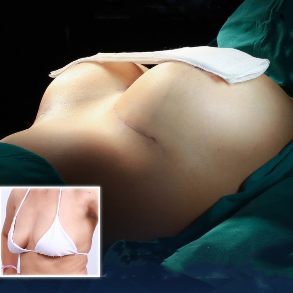 Antes y después de aumento de senos con implantes de silicona en Dr. Chen Surgery Hospital