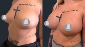 صور قبل وبعد شفط الدهون في منطقة الظهر للدكتور Hasan Celik