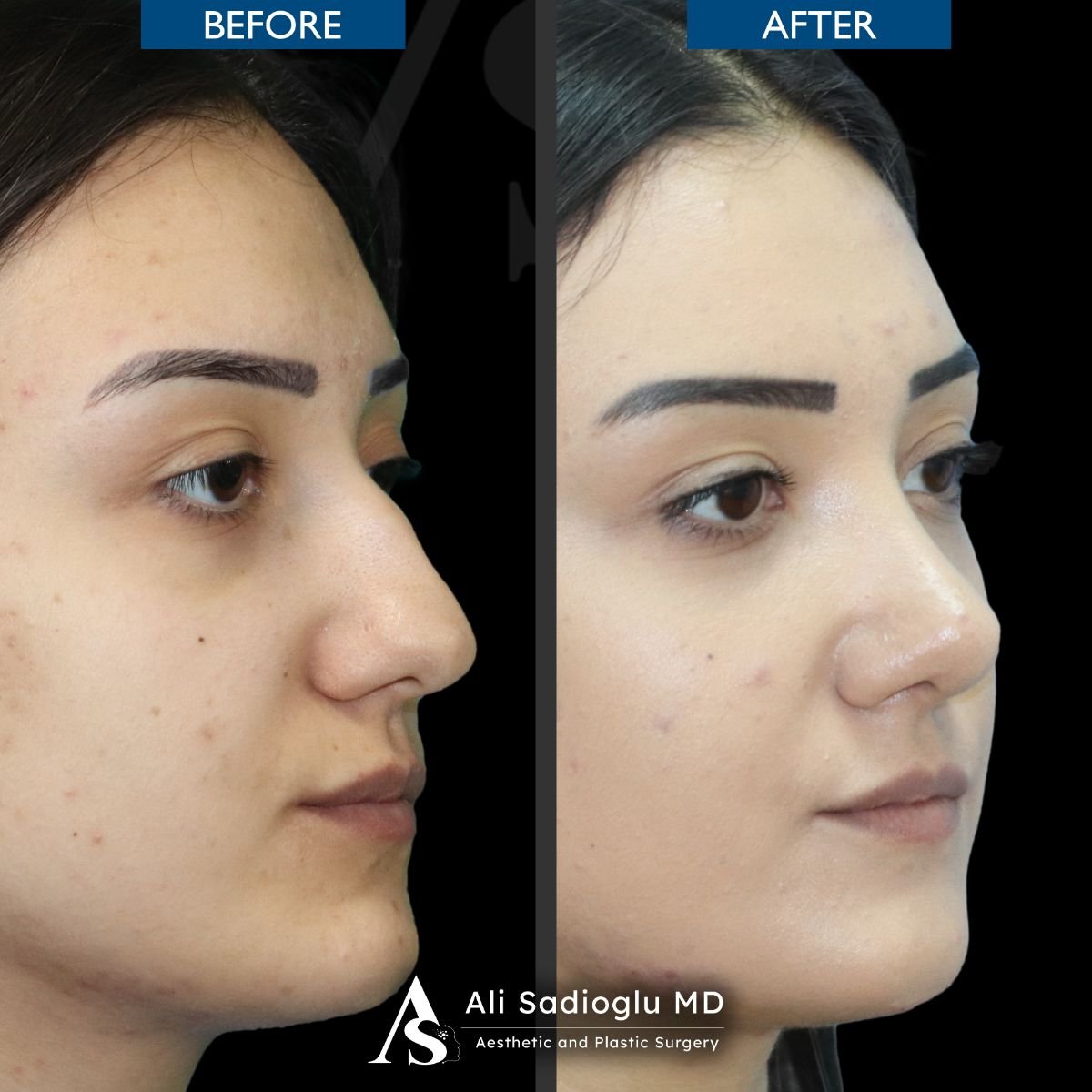 Resultados de rinoplastia antes y después en Dr. Safa Manav Clinic, remodelación nasal femenina
