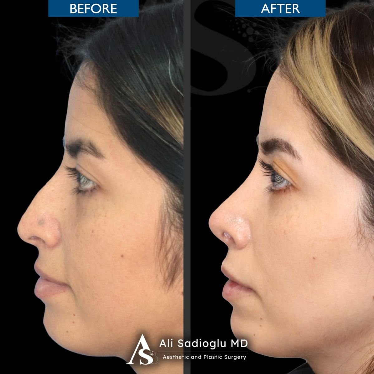 Before and after rhinoplasty results at Dr. Safa Manav Clinic, nose reshaping for women