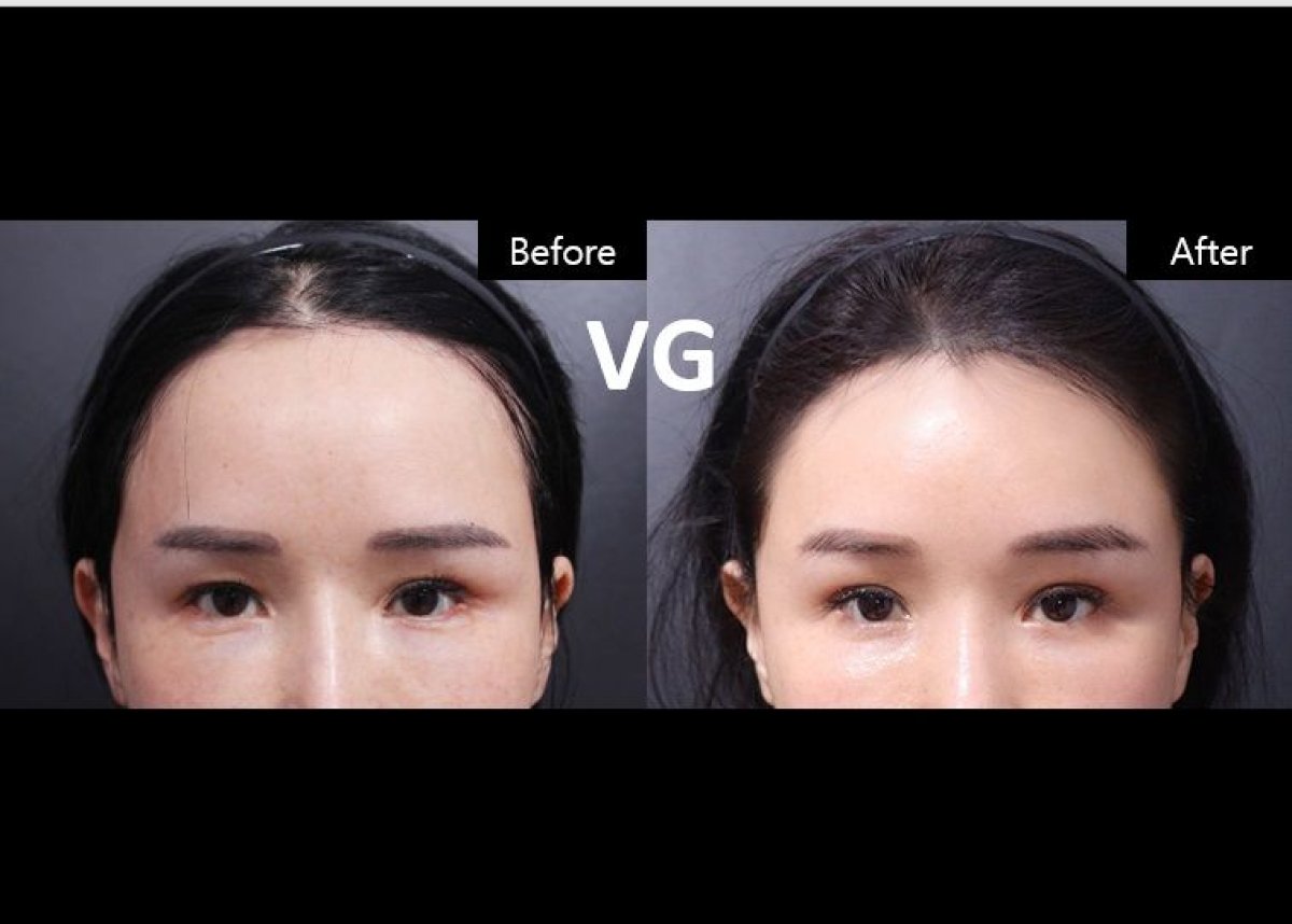 Blepharoplasty before and after results at VG Plastic Surgery – eyelid correction improvement