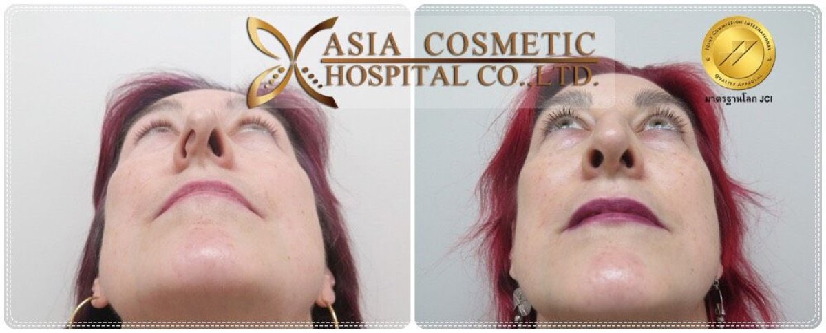 Before and after rhinoplasty results at Asia Cosmetic Hospital, improved nose shape and symmetry