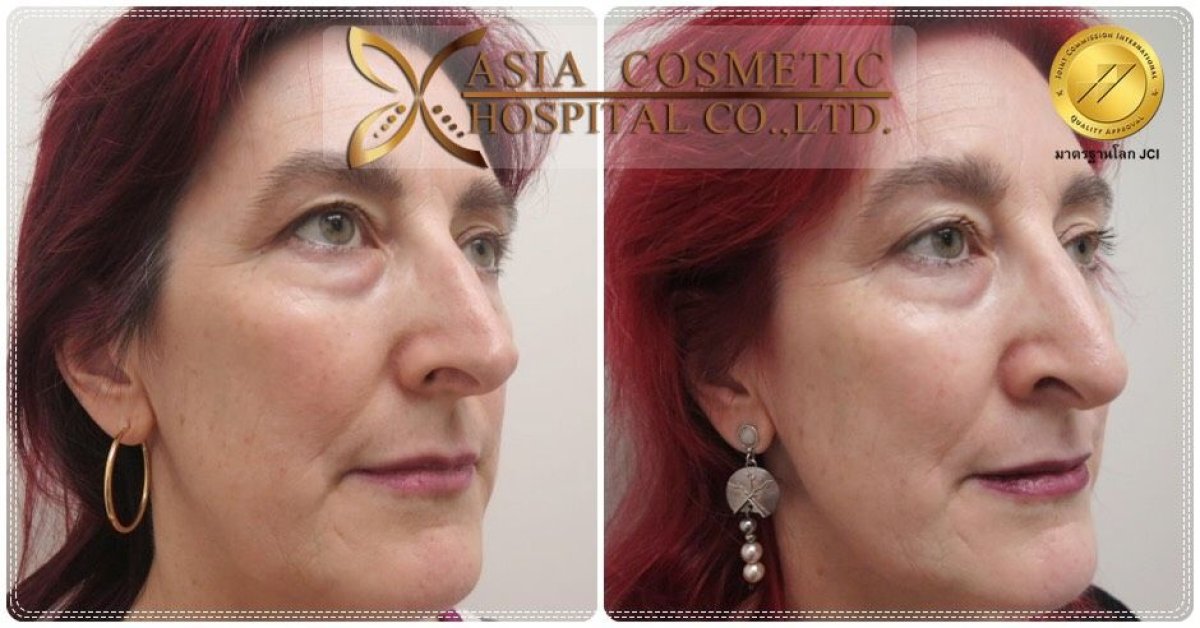 Facelift before and after results at Asia Cosmetic Hospital, visible facial rejuvenation effect