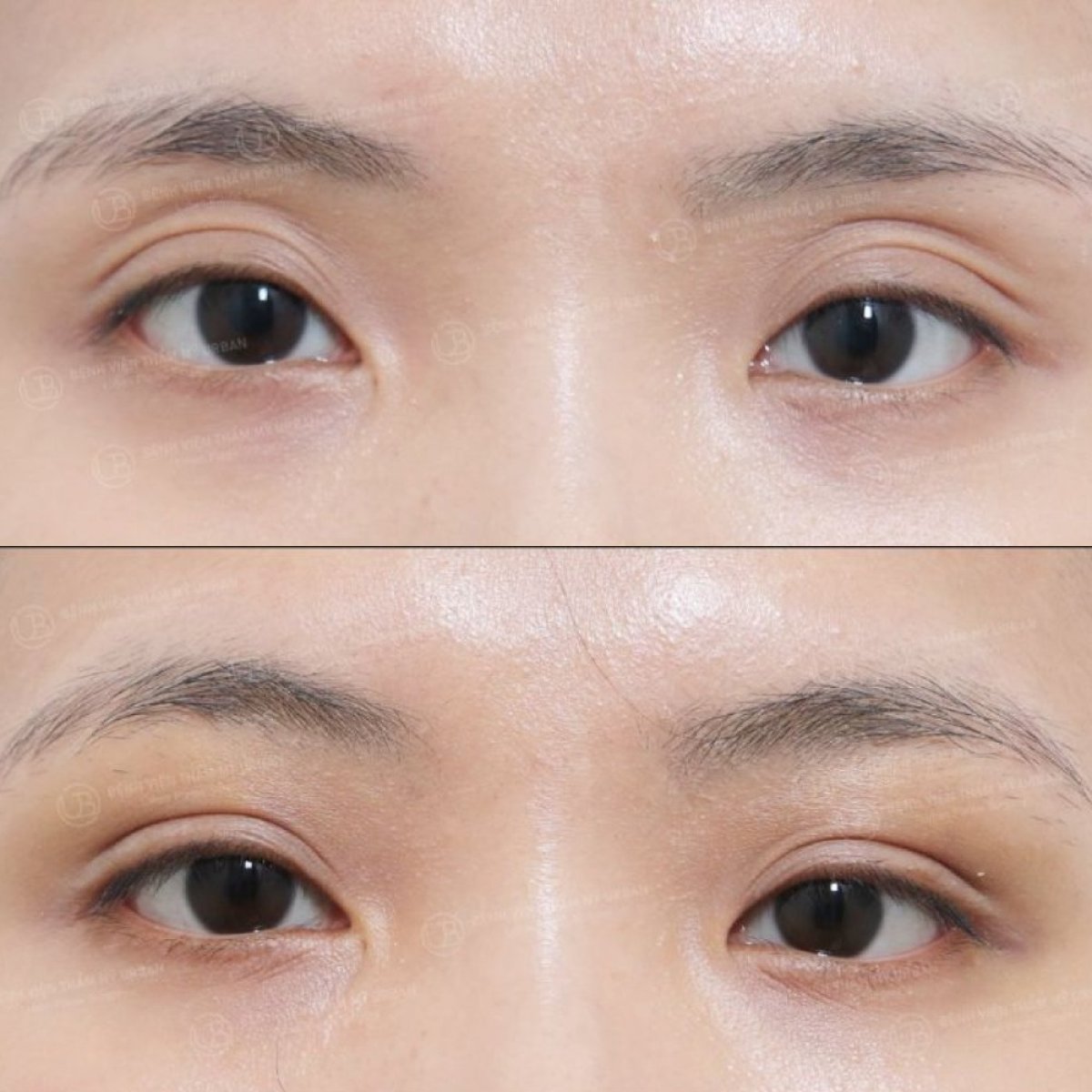 Vorher-nachher Lipofilling unter den Augen bei URBAN Plastic Surgery, sichtbares Volumen
