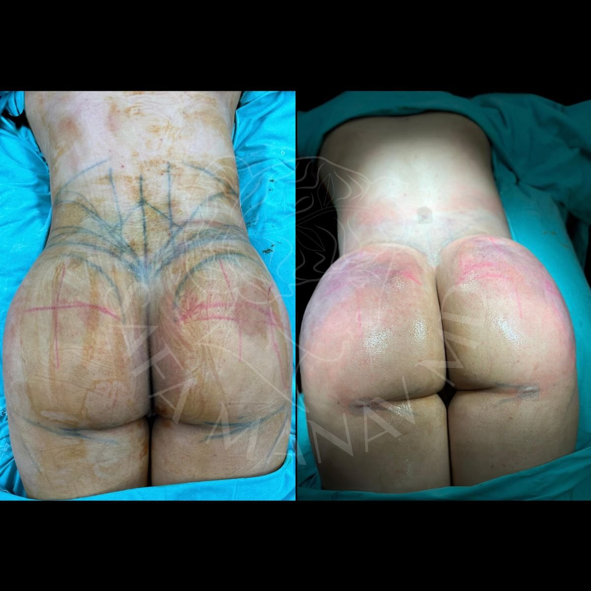 نتائج شفط دهون الظهر قبل وبعد في عيادة Dr. Safa Manav، تحسين شكل الجسم