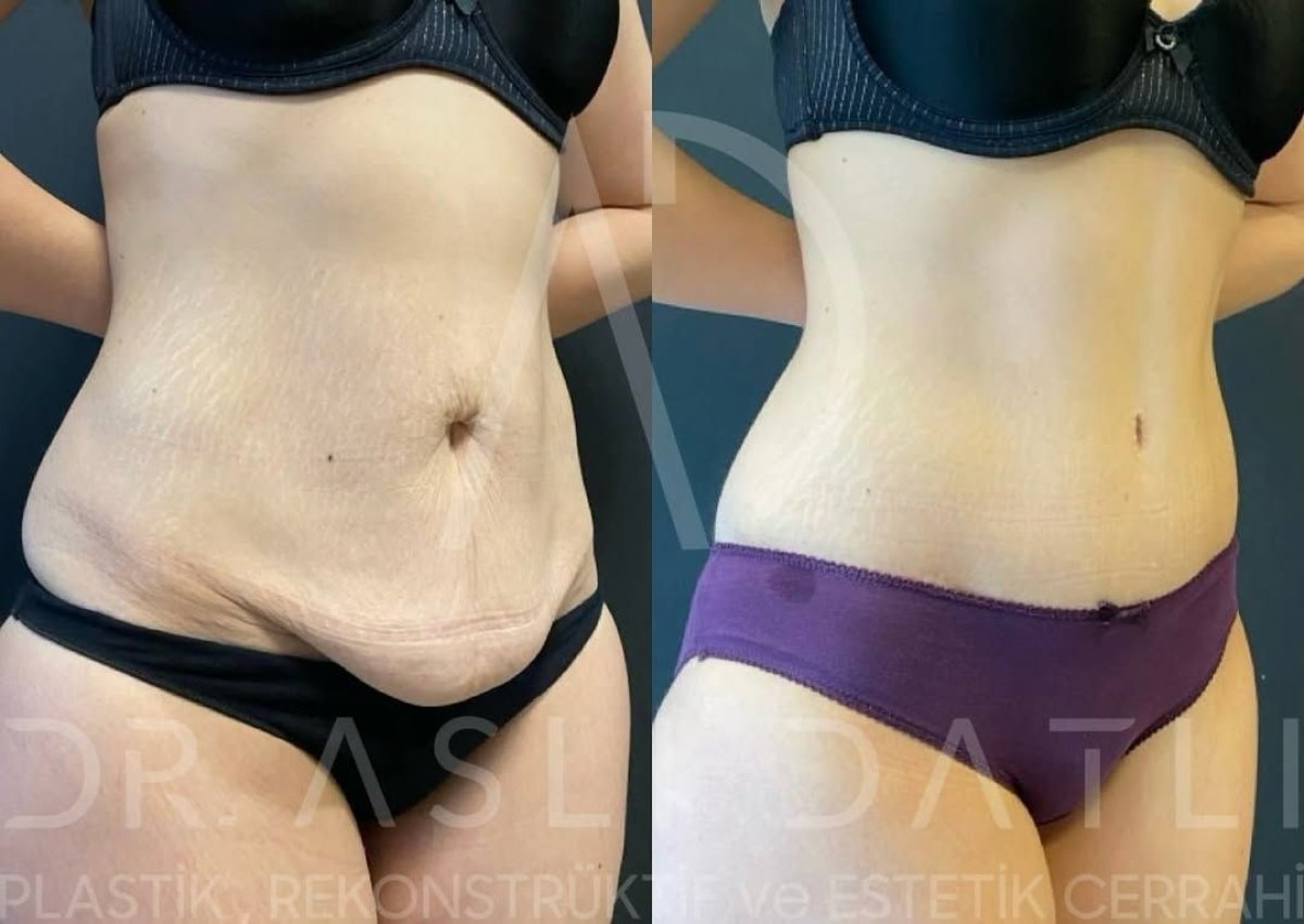 Résultats avant et après abdominoplastie à Liv Hospital Ulus, amélioration du contour abdominal