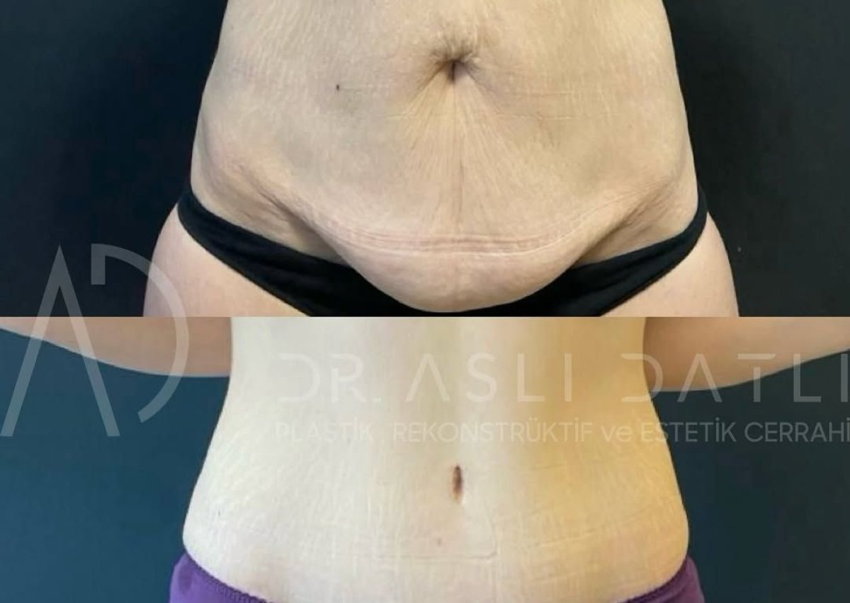 Before and after tummy tuck results at Liv Hospital Ulus – flatter, firmer abdominal contour